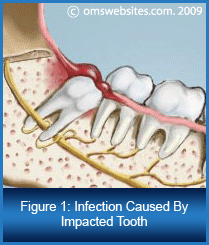 Figure 1 : Infection Caused by Impacted Tooth