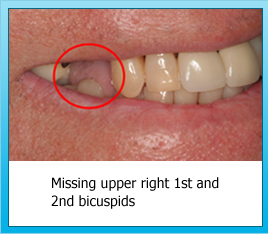 Missing upper right 1st and 2nd bicuspids