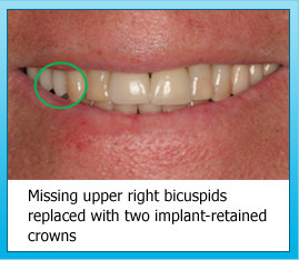 Missing upper right bicuspids replaced with two implant-retained crowns