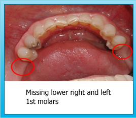 Missing lower right and left 1st molars