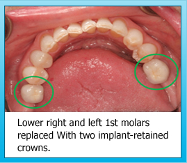 Lower right and left 1st molars replaced With two implant-retained crowns.