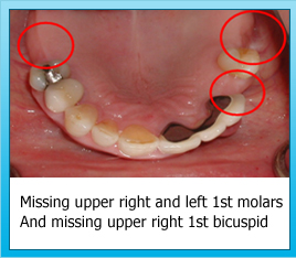 Missing upper right and left 1st molars And missing upper right 1st bicuspid