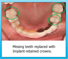 Missing teeth replaced with Implant-retained crowns.