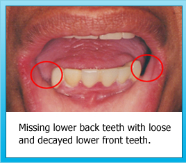 Missing lower back teeth with loose and decayed lower front teeth.
