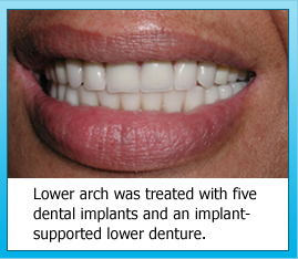 Lower arch was treated with five dental implants and an implant-supported lower denture.