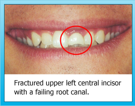 Fractured upper left central incisor
with a failing root canal.