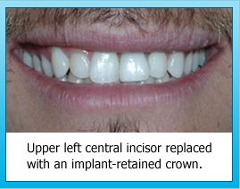 Upper left central incisor replaced with an implant-retained crown.
