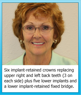 Six implant-retained crowns replacing upper right and left back teeth (3 on each side) plus five lower implants and a lower implant-retained fixed bridge.